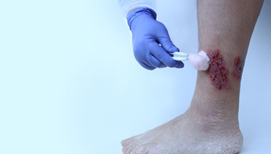 LESIONES Y ÚLCERAS ARTERIALES EN EXTREMIDADES INFERIORES